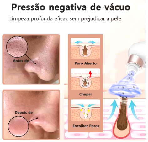 Removedor De Cravos Espinhas Sugador Poros Acne Sucção USB Recarregável